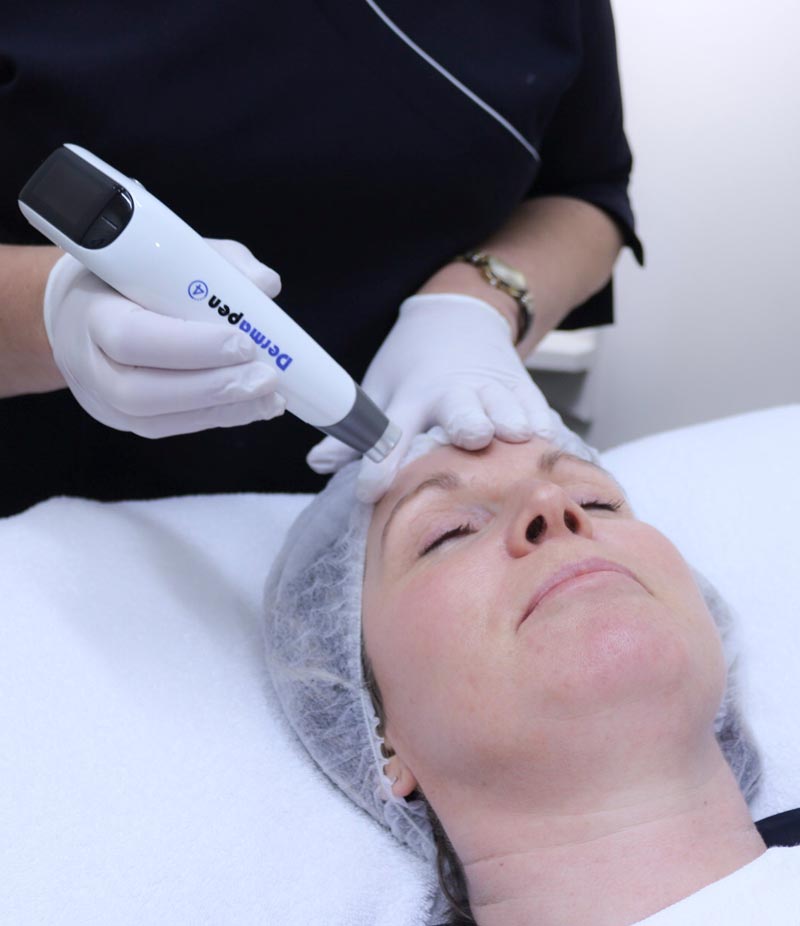 Services Collagen Induction treatments, Accent On Image, St Andrew Street, Dunedin, New Zealand